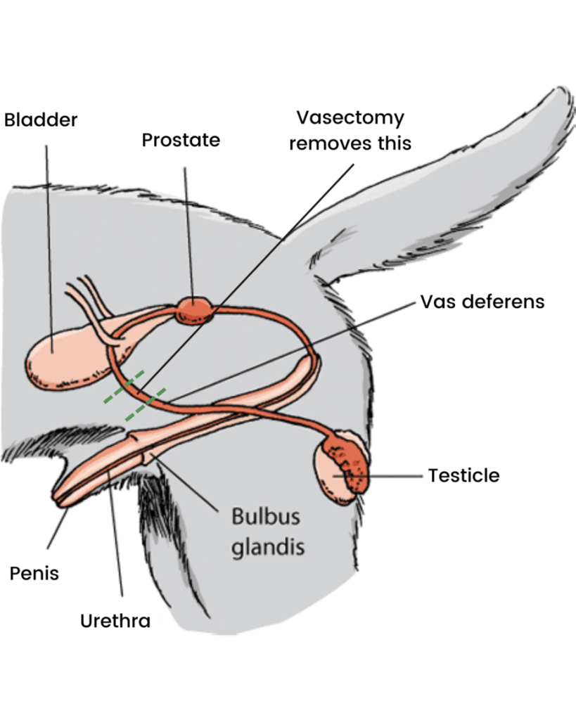\"vasectomy
